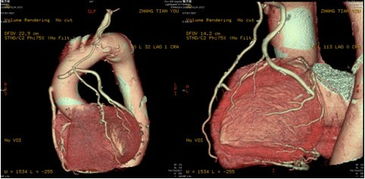冠状动脉CT检查的正常值