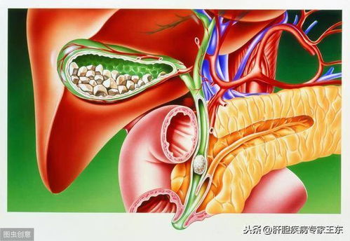 通过内镜将胆管结石取出后为什么还会再长结石,而且还反复发烧