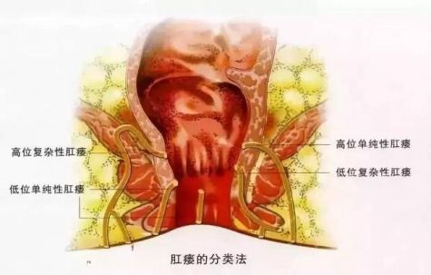 臀部两侧 茧子 牵出高位复杂肛瘘 51岁患者转诊济南市中心医院顺利脱险