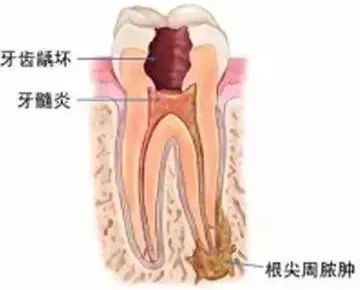 你今天还在 跳一跳 吗 牙齿 一跳一跳 的剧痛,可能是 