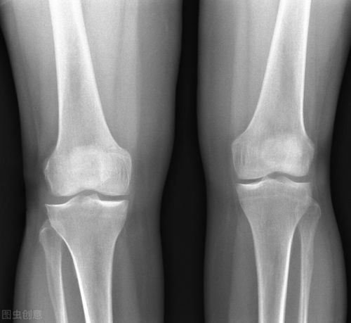 膝关节炎的治疗诊断方法