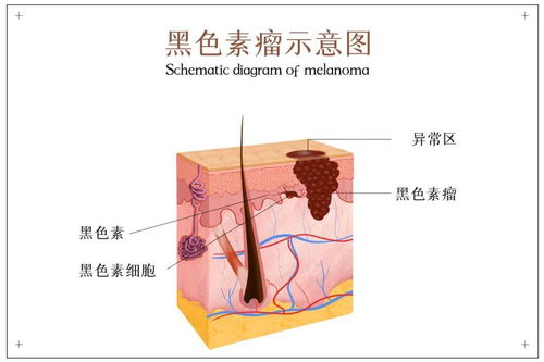 除 恶 惩 黑 专家助力诊疗新希望