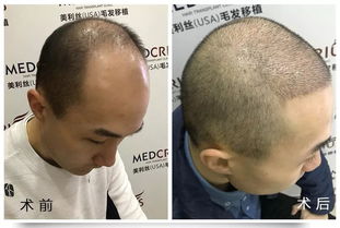 25岁秃顶大学生惊喜变身 6小时内 长 出头发 怎么做到的 脱发 少发必看
