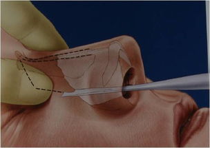 什么是宽鼻骨缩窄术