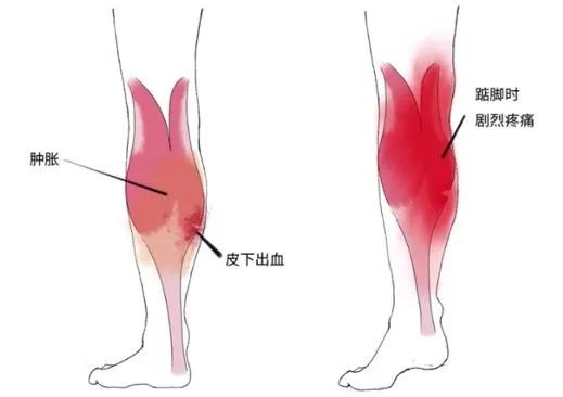 小腿拉伤怎么办 你做对了吗