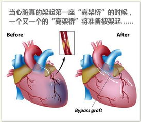 心脏搭桥的利弊是什么(心脏搭桥有什么作用)