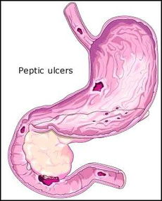 什么是应激性溃疡(什么是应激性溃疡胃溃疡)