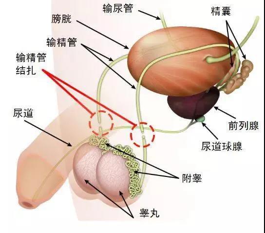 选择结扎避孕,会影响男性身体健康吗