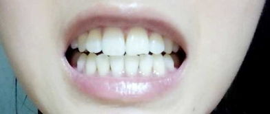 龅牙,牙套3年,后悔没有早点戴牙套 
