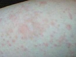 湿疹的症状图片，湿疹什么症状