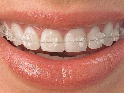 整形牙齿为什么查血－矫正期间为什么会出现牙龈出血现象？