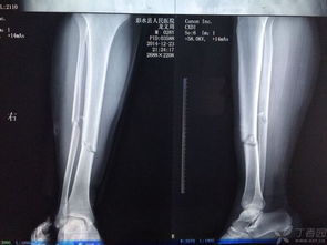 5岁患者左胫腓骨骨折弹性髓内钉固定 图片欣赏中心 急不急图文 Jpjww Com