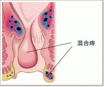 混合痔如何治 治疗费用是多少