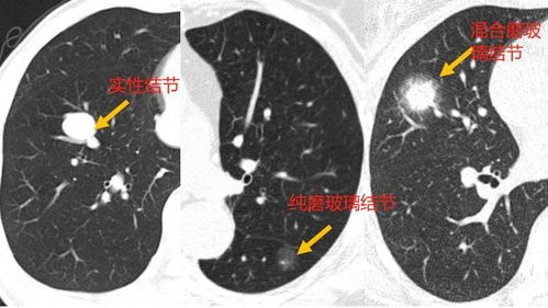 检查发现了肺结节怎么办 怎么知道是不是癌性结节