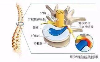 3大疗法让腰椎间盘突出患者不再坐立难安