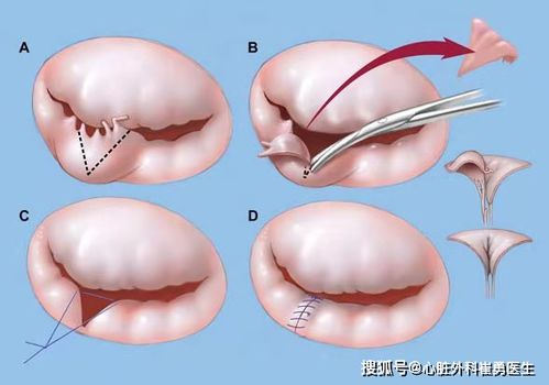 苏州心脏瓣膜自付费用大幅降低