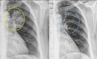体检发现肺部小结节怎么办 肺部小结节就是早期肺癌吗 