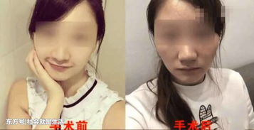 女子做了鼻头缩小术 拆线后想死的心都有 网友 不敢想象 