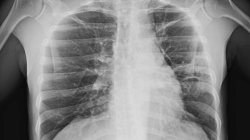 肺部结节会变为肺癌吗 不必紧张,听听专家怎么说 