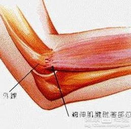 网球肘打封闭针好不好