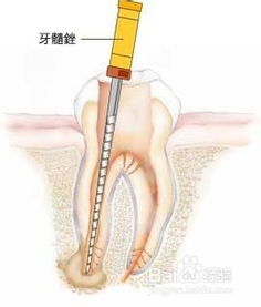 牙齿根管治疗后,为何还痛 