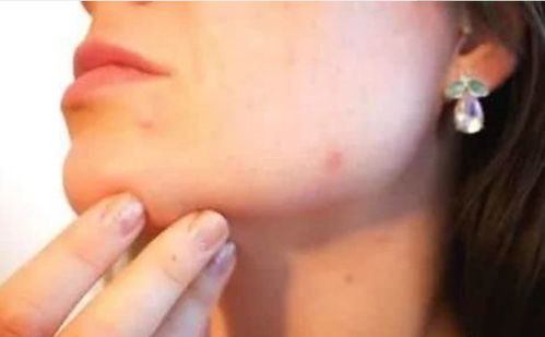 面部湿疹是怎么引起的 生活中这3种面部湿疹要注意