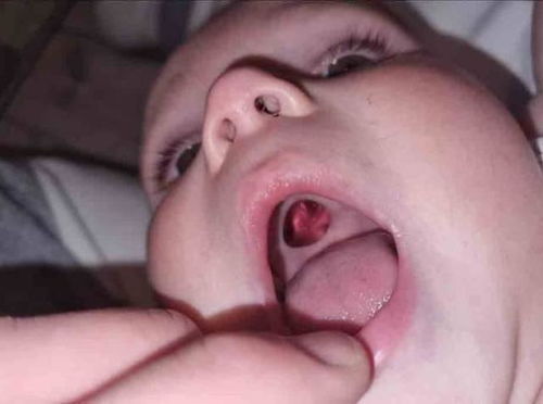 外国宝妈以为孩子嘴里有个洞,紧急送到医院后,才发现闹了笑话