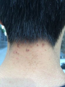脖子后面长了很多痘痘 