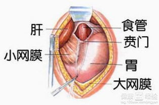 贲门癌晚期该怎么办